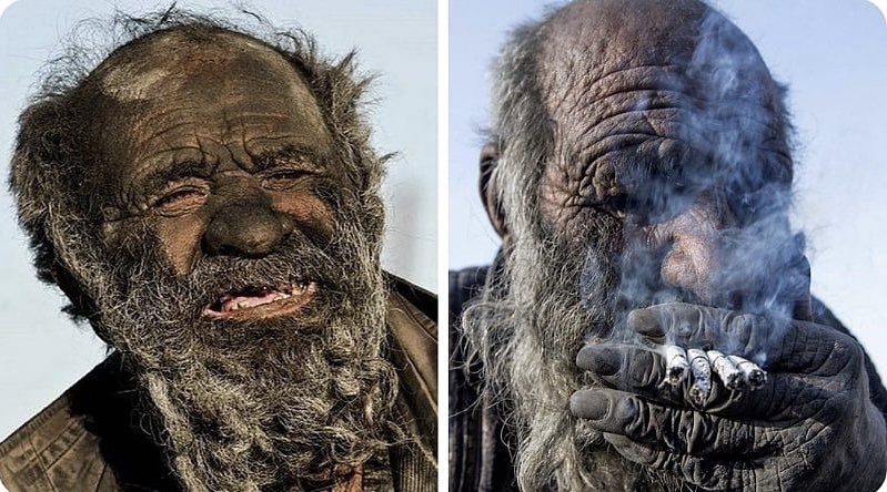 Amou Haji dubbed as the 'World's Dirtiest Man' was an Iranian man known for not bathing for more than 60 years. Despite his unhygienic lifestyle, he lived to the age of 94. He died a few months after bathing for the first time in 6 decades.