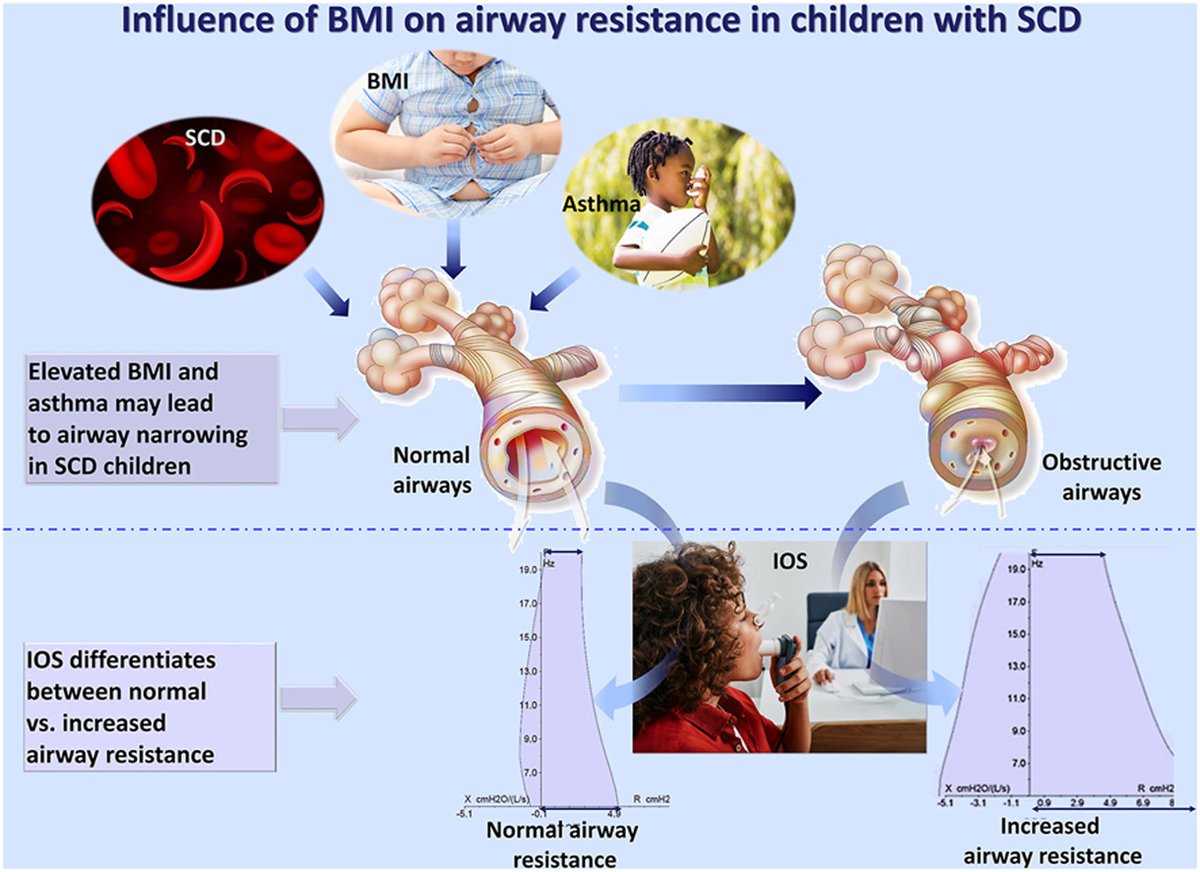 A longitudinal study conducted at
@PSUresearch @PennStHershey published in @resmedjournal demonstrated the influence of BMI on airway resistance in children with sickle cell disease. authors.elsevier.com/a/1iiJF3P3QuyT… Appreciate your thoughts..