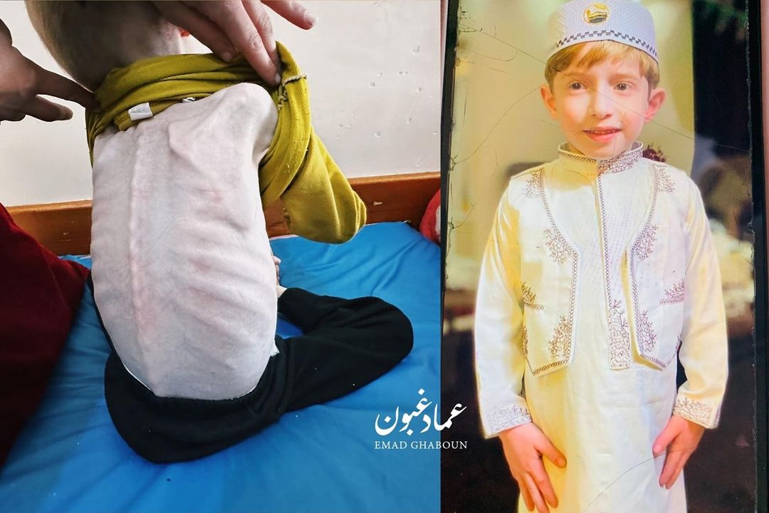 حالة فادي تسوء كل لحظة..!
في الصورة الطفل فادي الزنط قبل وبعد المجاعة، وهو مصاب بسوء التغذية والجفاف ومعرض للموت بسبب الجوع، والآن هو في مستشفى كمال عدوان شمال غزة وهو بحاجة عاجلة للسفر للعلاج