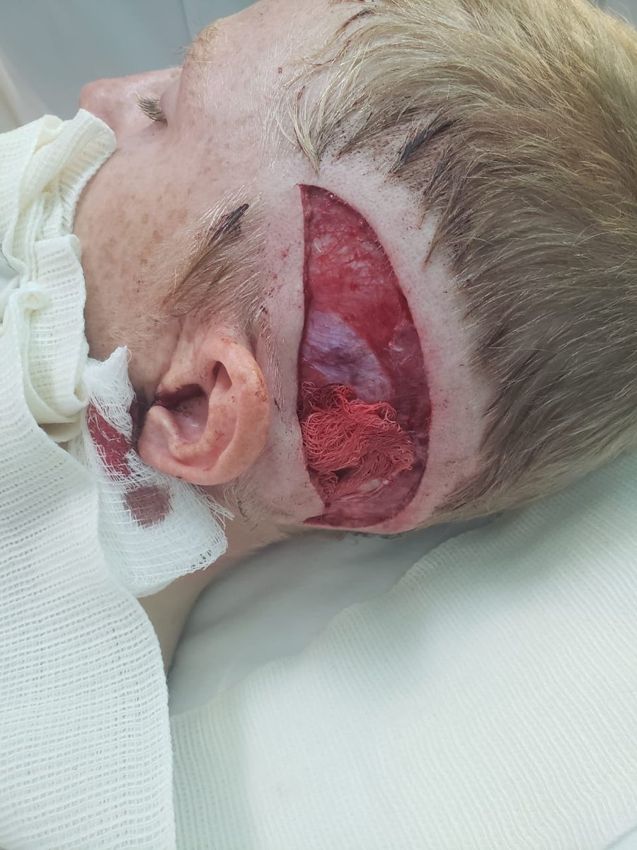 DSPedia21's tweet photo. Herida por machete al trabajar en huerto
#Pedia #Trauma #Pedialife #Vidadepediatra #Trabajosdecampo https://t.co/Zx5BzcUTVT