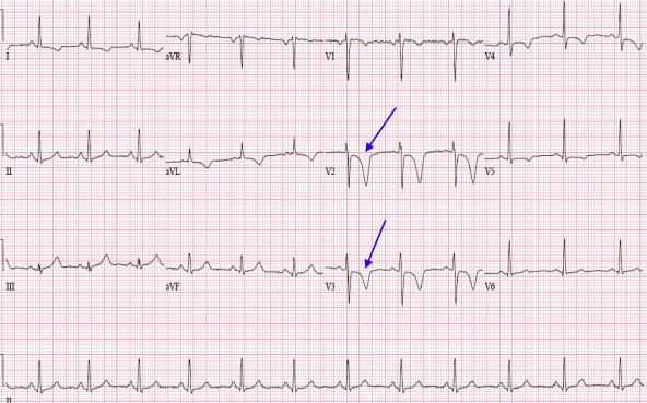 Wellens Syndrome is a clinical syndrome characterised by biphasic or deeply inverted T waves in V2-3, + chest pain. It is highly specific for critical stenosis of the left anterior descending artery (LAD).