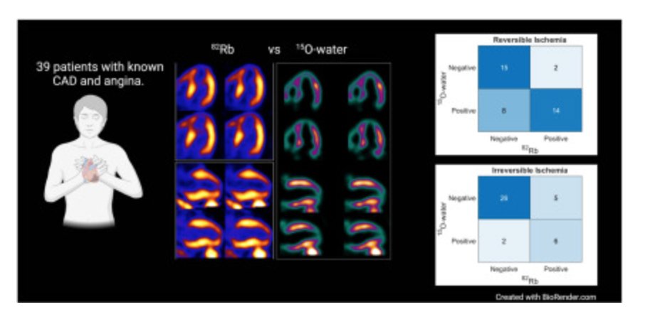 In a study of 39 pts undergoing both 82Rb & 15O-water PET, there was 74% agreement in regional reversible ischemia & global disease. Correlation between MBF was similar to prior studies. @AUHdk @LarsTolbod Editorial Ibrahim Danad & Roel Driessen. 👉bit.ly/48M2ybq #CVNuc