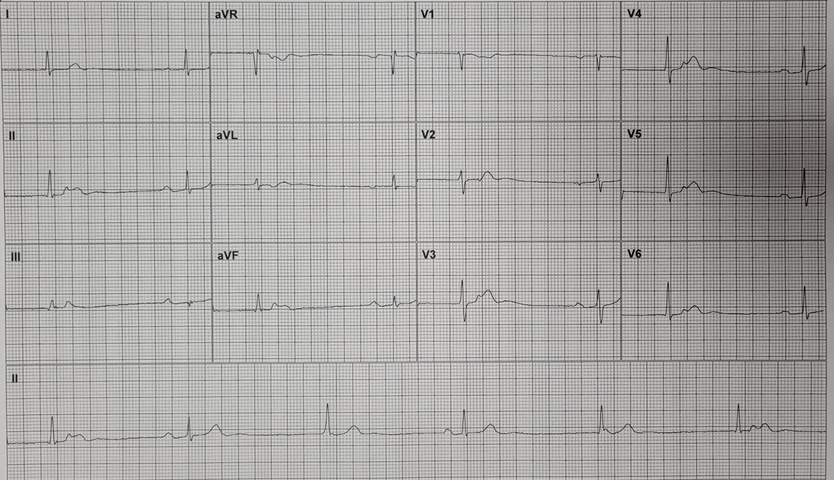 Arron_Pearce_'s tweet image. Male in his 60s noted to be bradycardic. He is asymptomatic