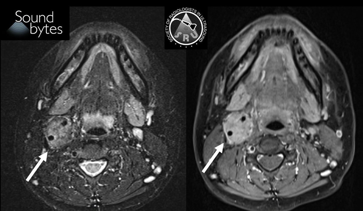 Answer to last week's case: Paraganglioma/ carotid body tumor Case Courtesy of Dr. Preethi Raghu MD; UCSF Note the hypoechoic mass splaying the internal and external carotid arteries. Subsequent MRI shows a T2 hyperintense mass that is avidly enhancing. @preethiraghumd