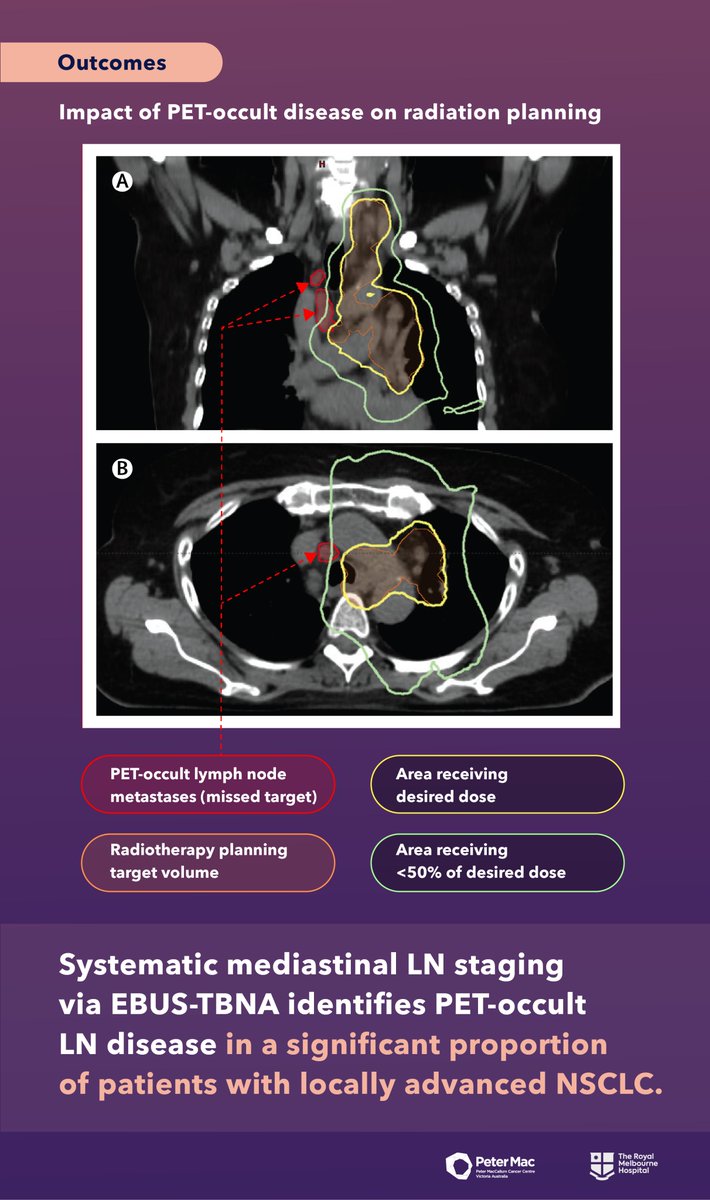 4/ Some rapid, more easily digestible graphics of our <a href="/LancetRespirMed/">The Lancet Respiratory Medicine</a> paper shorturl.at/pADQ9 and key outcomes below! #lcsm #oncology <a href="/OncoAlert/">OncoAlert</a> <a href="/TargetingCancer/">Targeting Cancer</a> <a href="/TheRMH/">The Royal Melbourne Hospital</a> #radonc. Thank you everyone 🙏🏾🙏🏾🙏🏾 and interested in thoughts!!!