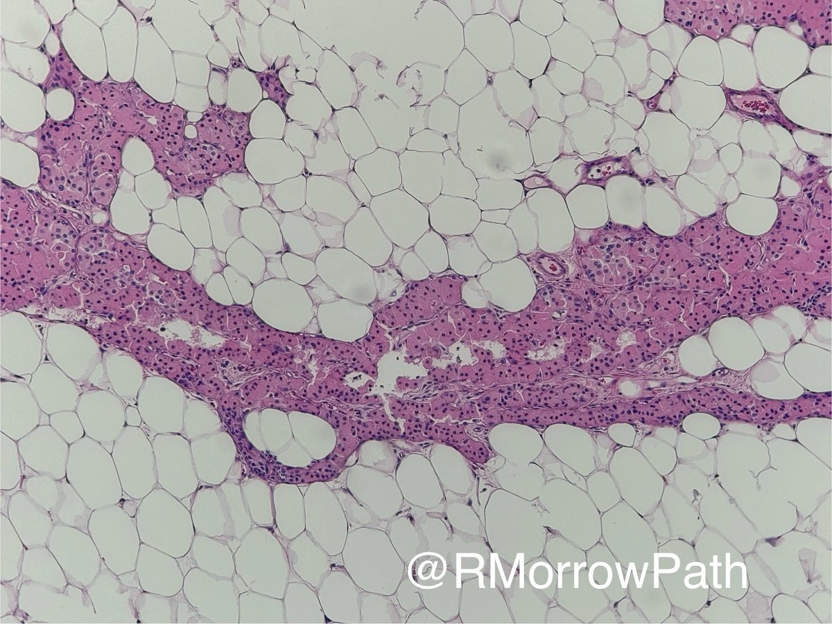 Prepping a head and neck reg slide seminar and came across this beauty. We’re in the parotid, let’s say middle aged female. Vote below for your preferred diagnosis #pathology #headandneckpath #entpath