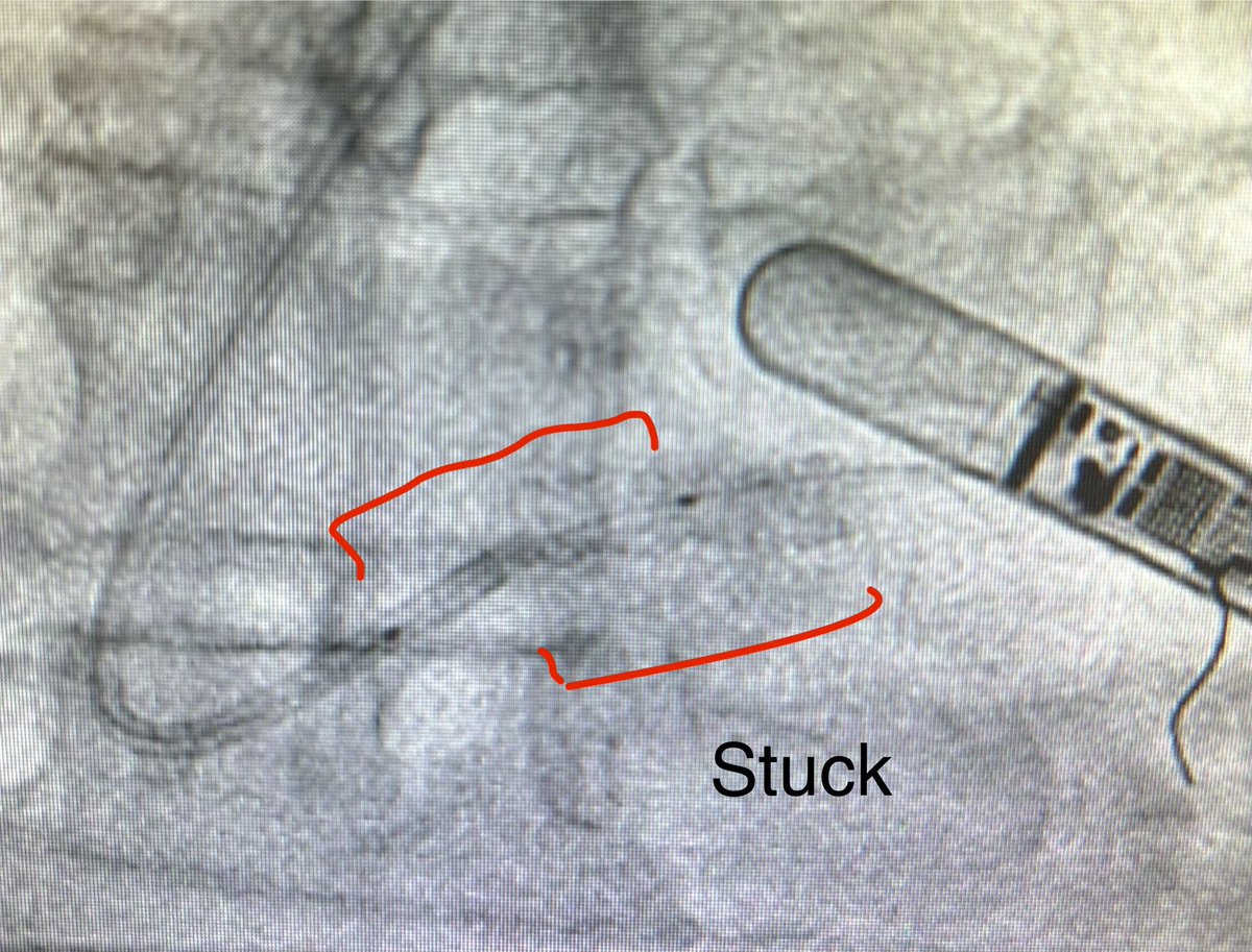 GEAR stuck in LEFT MAIN 😳 5.0 x 16 mm DES ➡️ LM - LAD Stent balloon withdrawn partway to semi-POT LM at higher pressure (Fig 1) Stent balloon could not be removed ➡️ shaft stretched as I pulled 👀 (Fig 2) What now?