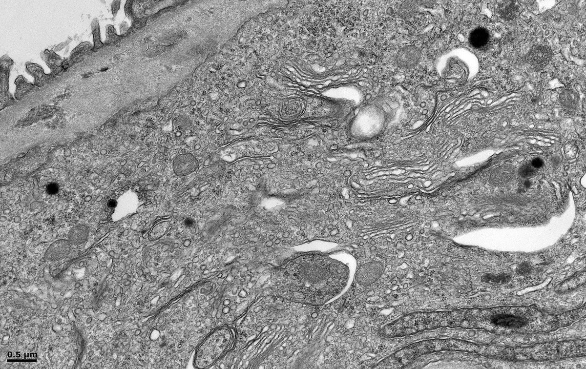 Renal Tx Bx for rejection v infection. IHC for CMV is negative. #electronmicroscopy finds the 'needle in a haystack' with virions ultrastructurally consistent with herpesvirus in a single infected endothelial cell. Note the pleomorphic nucleus. Proliferation of Golgi in image 4.