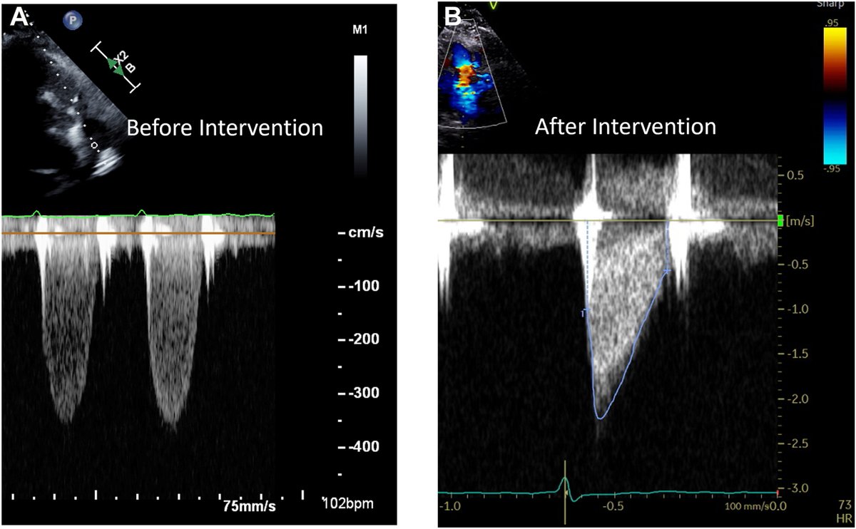 ASE360's tweet photo. We describe a 79-year-old with congenital pulmonary valve stenosis due to a unicommisural valve who underwent successful transcatheter valve dilation with an excellent hemodynamic and clinical response. https://t.co/echWv9W9Fq
#CASESpecialIssue #10DaysofCASE #ACHD @CASEfromASE https://t.co/c51NDI9ia3