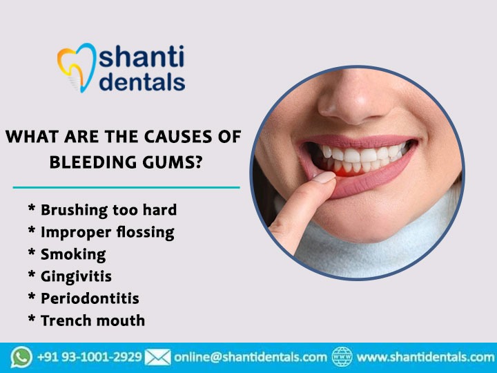 Get Best Bleeding Gums Treatment in Rohini

Visit Us: shantidentals.com

#Gumdisease #Infection #Tooth #Gum #Gumproblem #GumTreatment #flossing #Gingivitis #Gumproblem #wednesdaywisdom #wednesdayvibes #wednesdaymotivation #wednesdaymood