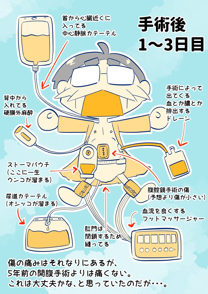 去年退院してからちょうど1年!
大腸全摘後も何事もなく原稿描けてます。
同じような手術を考えてる方や術後の入院生活で何かの参考になれば〜

(再掲)大腸から肛門まで全部とる男 
報告レポ(1/3) 

#クローン病 #エッセイ漫画 