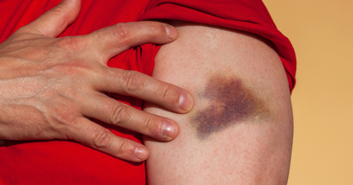 RehabPainMedJ's tweet photo. A bruise, also known as a contusion, is a type of hematoma of tissue, the most common cause being capillaries damaged by trauma, causing localized bleeding that extravasates into the surrounding interstitial tissues.
#bruise #contusion #hematoma #tissue #capillaries #trauma https://t.co/M6c0NiNBCp