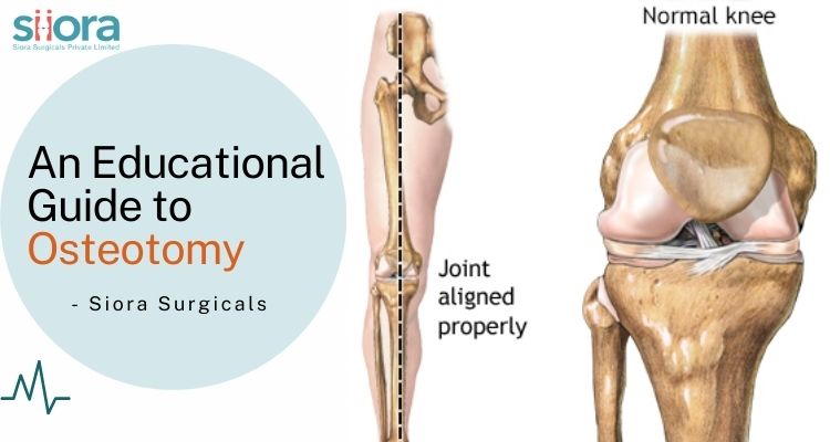 siorasurgicals's tweet image. An Educational Guide to Osteotomy: Learn about precise bone reshaping for improved joint health. Explore personalized solutions for osteoarthritis, hip dysplasia and more. evernote.com/shard/s514/cli…
@siorasurgicals #Osteotomy #SurgicalInnovation #JointFunction #HealthcareEducation