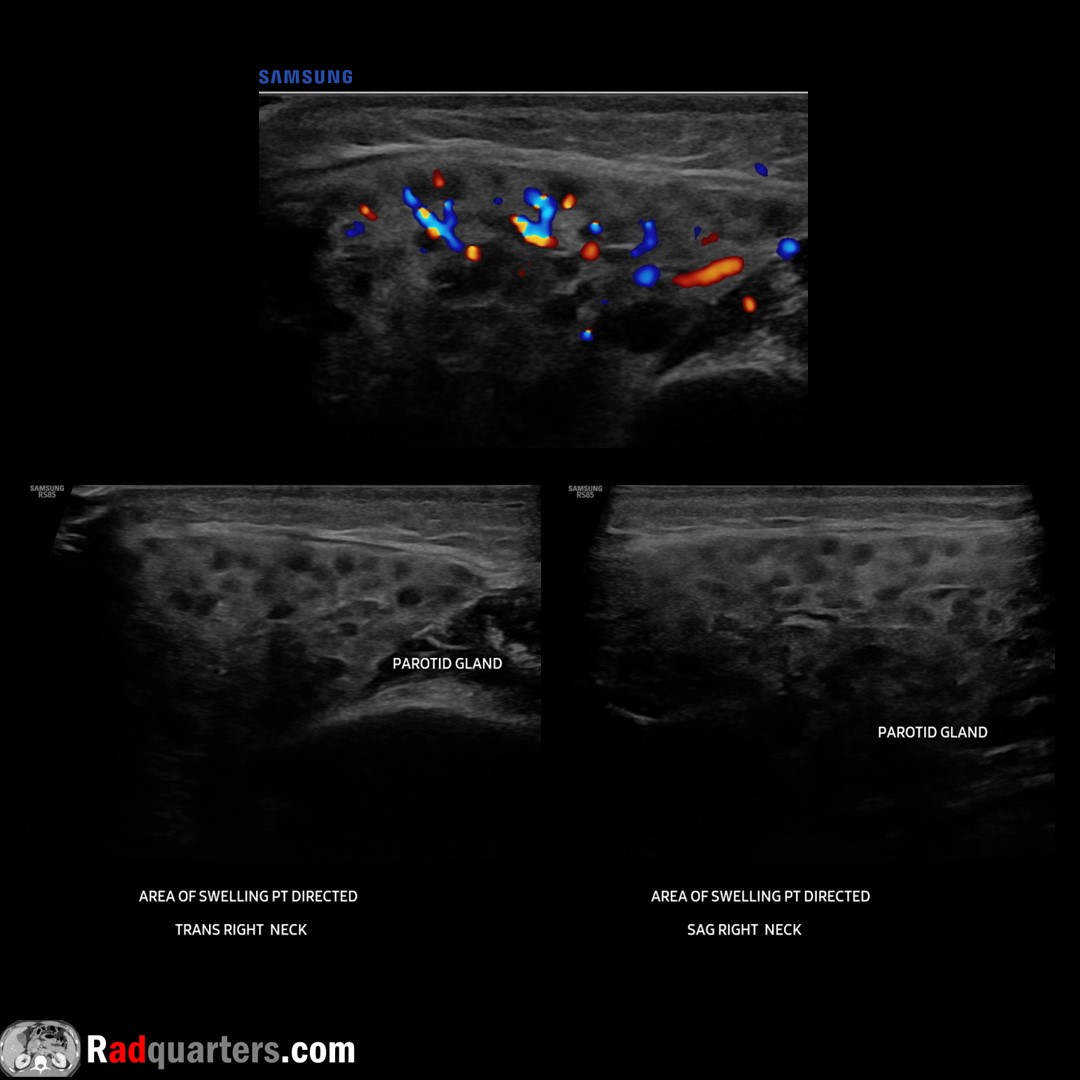 Pomegranate sign of acute parotitis. Uniform anechoic foci scattered throughout the gland. Similar to pseudonodular “giraffe” ultrasound pattern that can be seen in Hashimoto’s thyroiditis. Watch📽️ to learn more: bit.ly/rq-parotitis @BostonImaging @SamsungHealth #FOAMrad