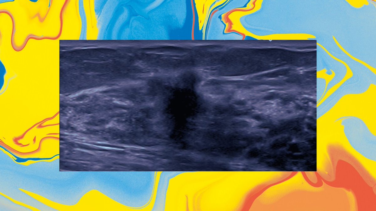 Diese #RÖKODIGITAL Woche steht ganz im Zeichen der Mammadiagnostik sowie des Ultraschalls. Die Bandbreite reicht von den Sonografie-Grundlagen bis zum KI-Praxischeck in der Mammadiagnostik: roentgenkongress.de/programmverzei… #RÖKO2024 #Radiologie #Fortbildung #Ultraschall #Mammadiagnostik