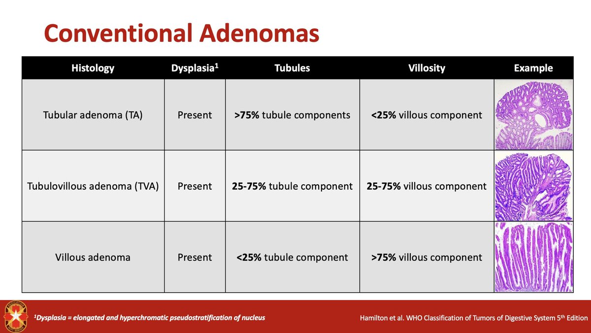 Conventional Adenomas of the Colon

▪️Tubular adenoma
▪️Tubulovillous adenoma
▪️Villous adenoma 

🔬% tubule component
🔬% villous component
🔬ALL have dysplasia present!

NOTE: reliability of dysplasia has high pathologist inter-observer variability! 

🔗 pubmed.ncbi.nlm.nih.gov/28396276/