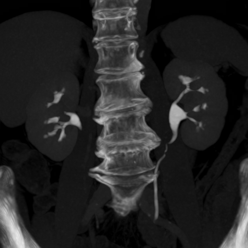 70 yo woman with hematuria, what's your diagnosis? case from @MIRimaging #meded #radiology #abdrad #urology #nephrology