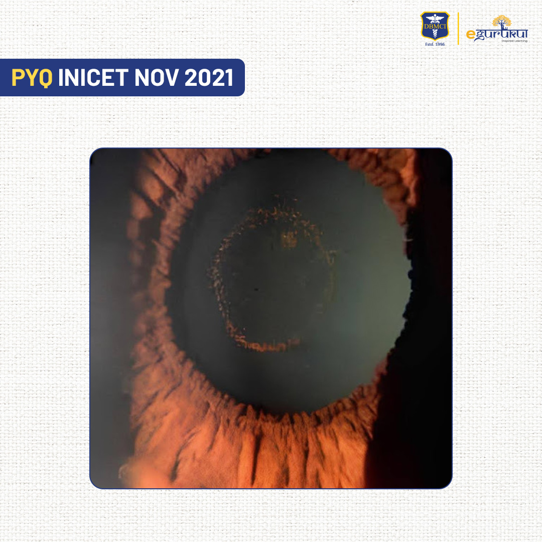 ○ Cataracts associated with blunt trauma are often stellate or rosette  initially, image size:1080x1080