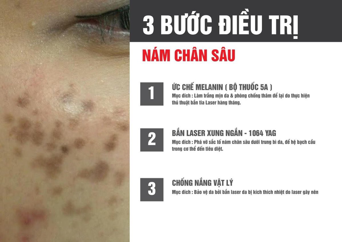 bapbebong1's tweet photo. 3 BƯỚC ĐIỀU TRỊ NÁM CHÂN SÂU https://t.co/vxiQfJe52W