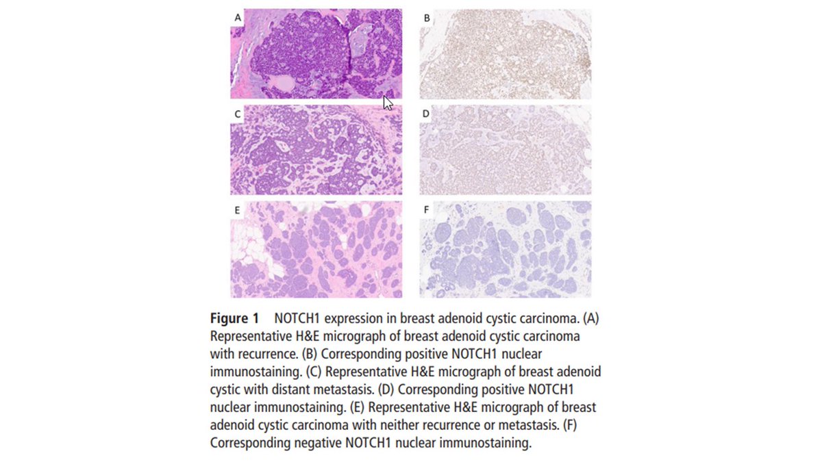 AlirezaSalem2's tweet image. Very excited to share our paper (Impact of NOTCH1 expression in primary breast adenoid cystic carcinoma) just published in @JClinPath_BMJ
#pathology #PathTwitter #breastpath #pathresidents #BreastPatholog1
@ColumbiaPath @Columbia @MDAndersonNews @TheISBP 
doi.org/10.1136/jcp-20…
