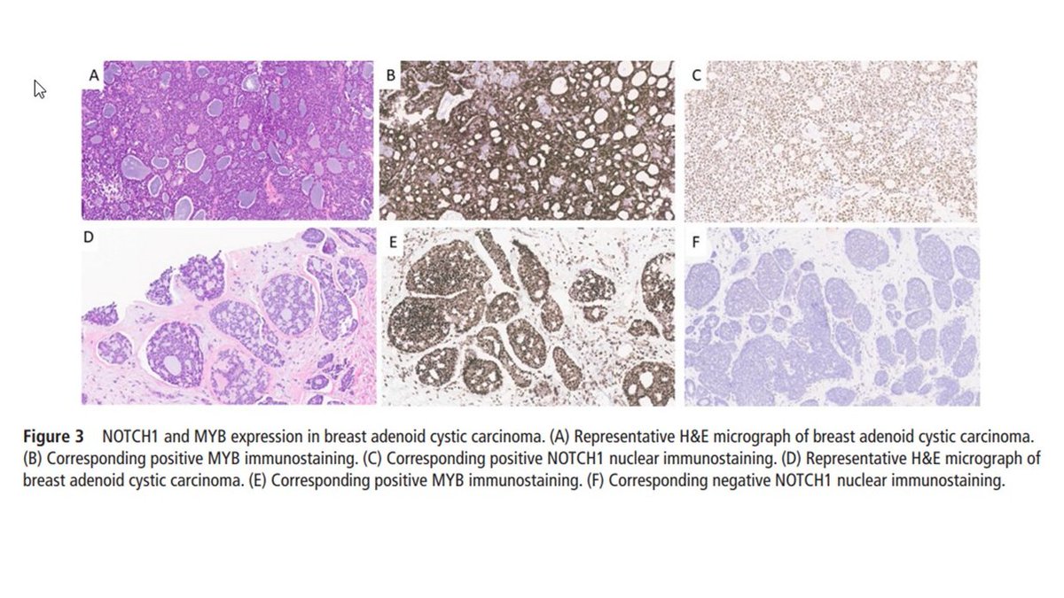 AlirezaSalem2's tweet image. Very excited to share our paper (Impact of NOTCH1 expression in primary breast adenoid cystic carcinoma) just published in @JClinPath_BMJ
#pathology #PathTwitter #breastpath #pathresidents #BreastPatholog1
@ColumbiaPath @Columbia @MDAndersonNews @TheISBP 
doi.org/10.1136/jcp-20…