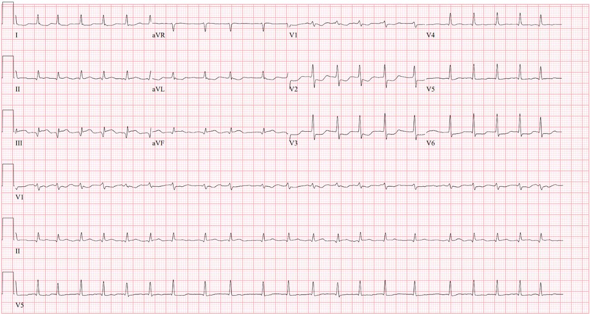 Interesting case. 65 year old male with chest pain. Found to have splenic rupture on imaging. Taken to the OR for splenectomy. 2L blood loss. Initial Hgb 10 but down to 7 g/dL postoperatively. However, on chart review, initial troponins continued to rise over next few days.…