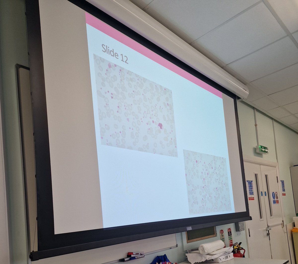 Teaching MSc Biomedical Science students all about myeloproliferative neoplasms this morning @KeeleUniversity lovely practical microscopy session with quiz