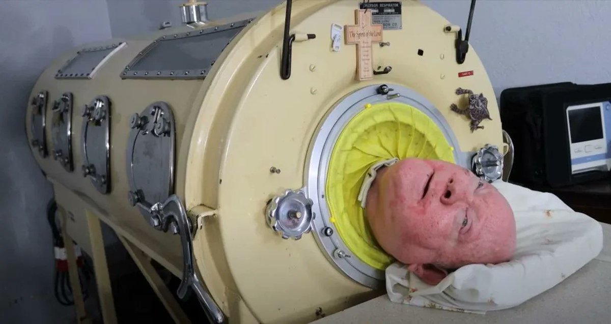 Paul Alexander (78) dies after being in an iron lung for 70 years after a Polio infection.