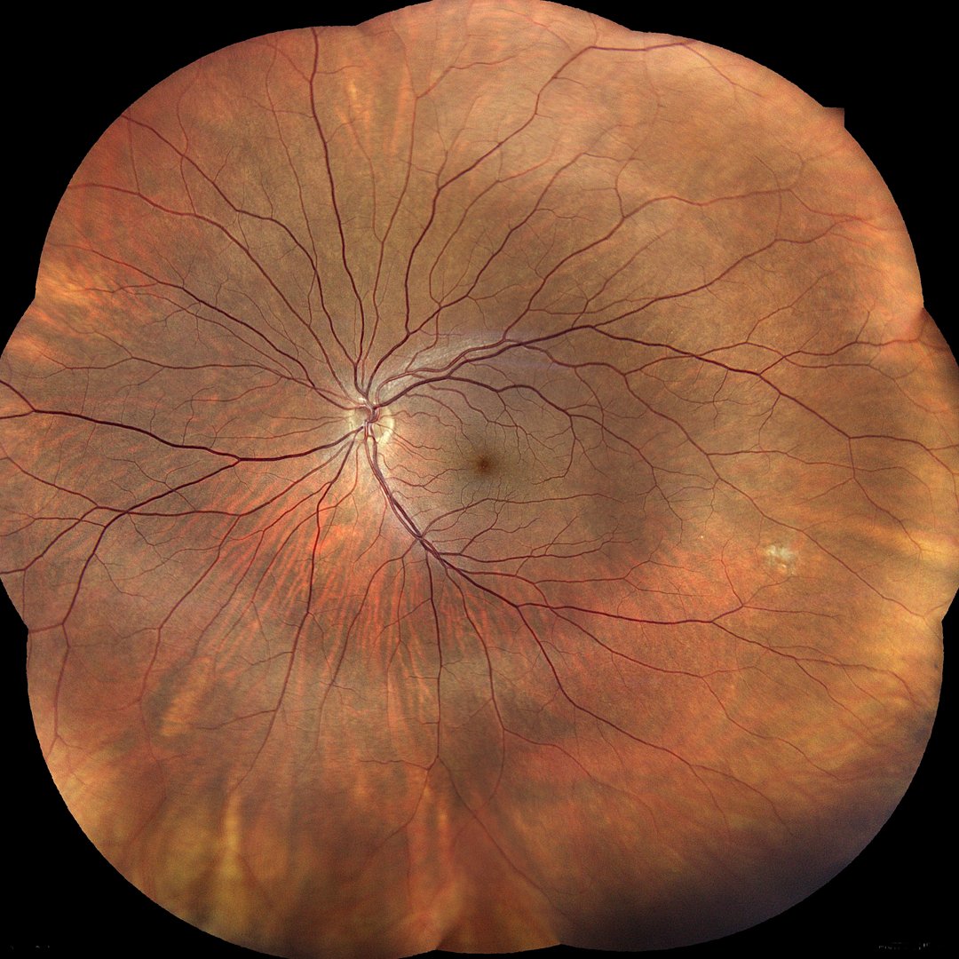 MLInstruments's tweet photo. iCare EIDON Ultra-Widefield Module 

Thanks to the new iCare EIDON Ultra-Widefield Module it is now possible to gain a wider view of the retina and get more information about the signs of pathologies in the periphery, up to 200°. 

sales@main-line.co.uk https://t.co/AICGZr0jwe