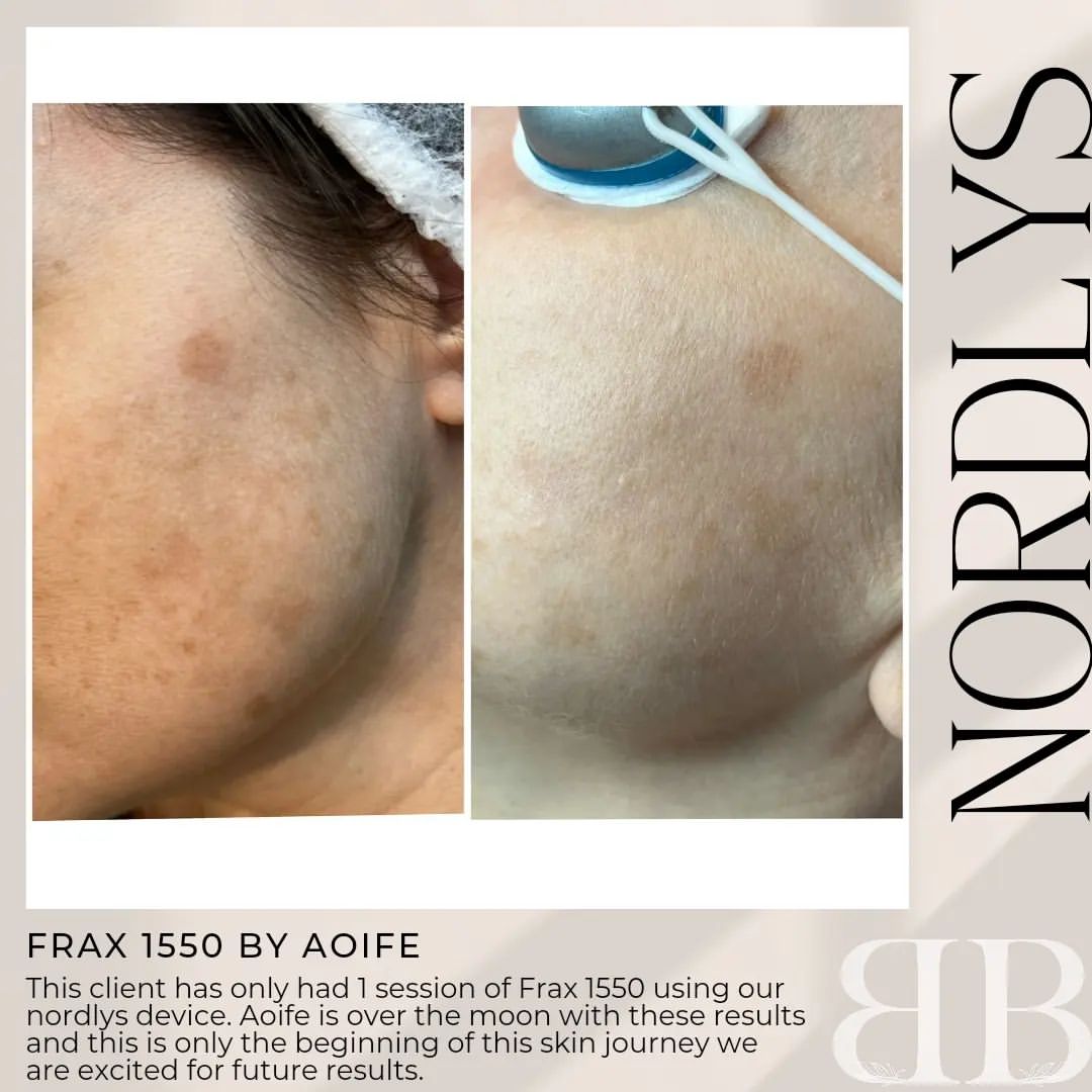 BeyondBeauty_ie's tweet photo. Amazing results with our Frax 1550 by Aoife. This is only the beginning of this ladies' skin journey. Watch this space !!
https://t.co/X0eExLisS2 https://t.co/QRHgQwvQSk
