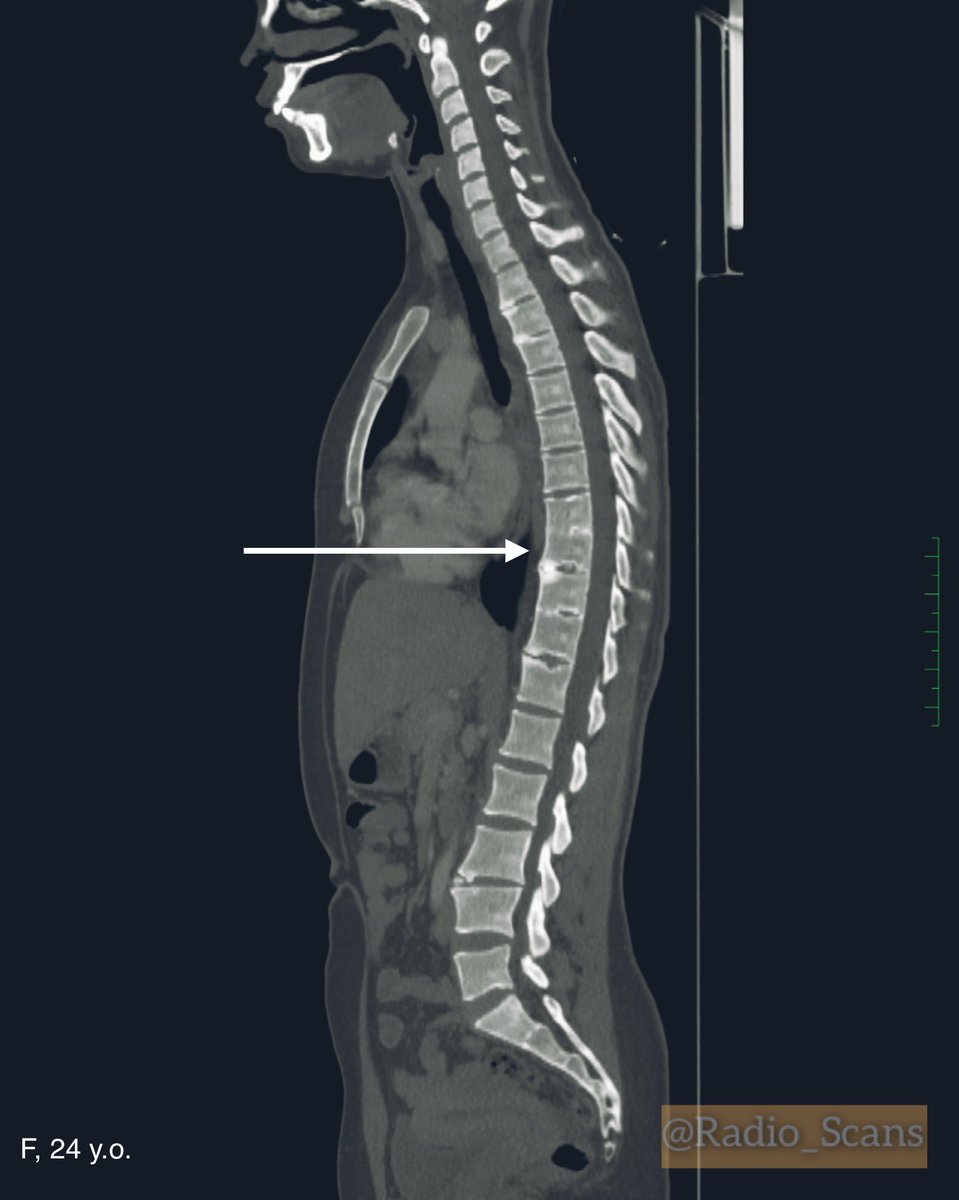 Radio_Scans's tweet image. Block vertebrae. CT scans of a 24-year-old female. Notice violation of a failure to separate Th8, Th9, Th10 and Th11 vertebral bodies and blocked vertebrae too.
#computed #tomography #ctscan #64slice #blocked #vertebra #failure #separation #vertebral #bodies #anatomic #variant