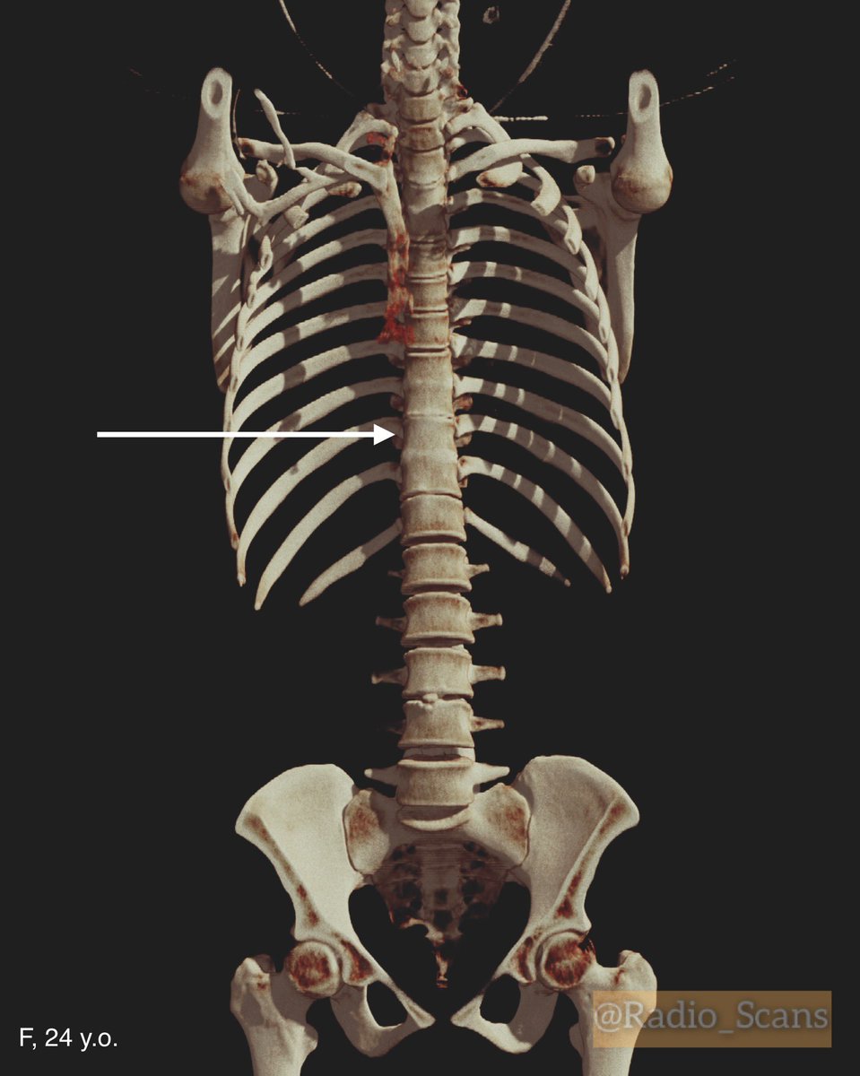 Radio_Scans's tweet image. Block vertebrae. CT scans of a 24-year-old female. Notice violation of a failure to separate Th8, Th9, Th10 and Th11 vertebral bodies and blocked vertebrae too.
#computed #tomography #ctscan #64slice #blocked #vertebra #failure #separation #vertebral #bodies #anatomic #variant