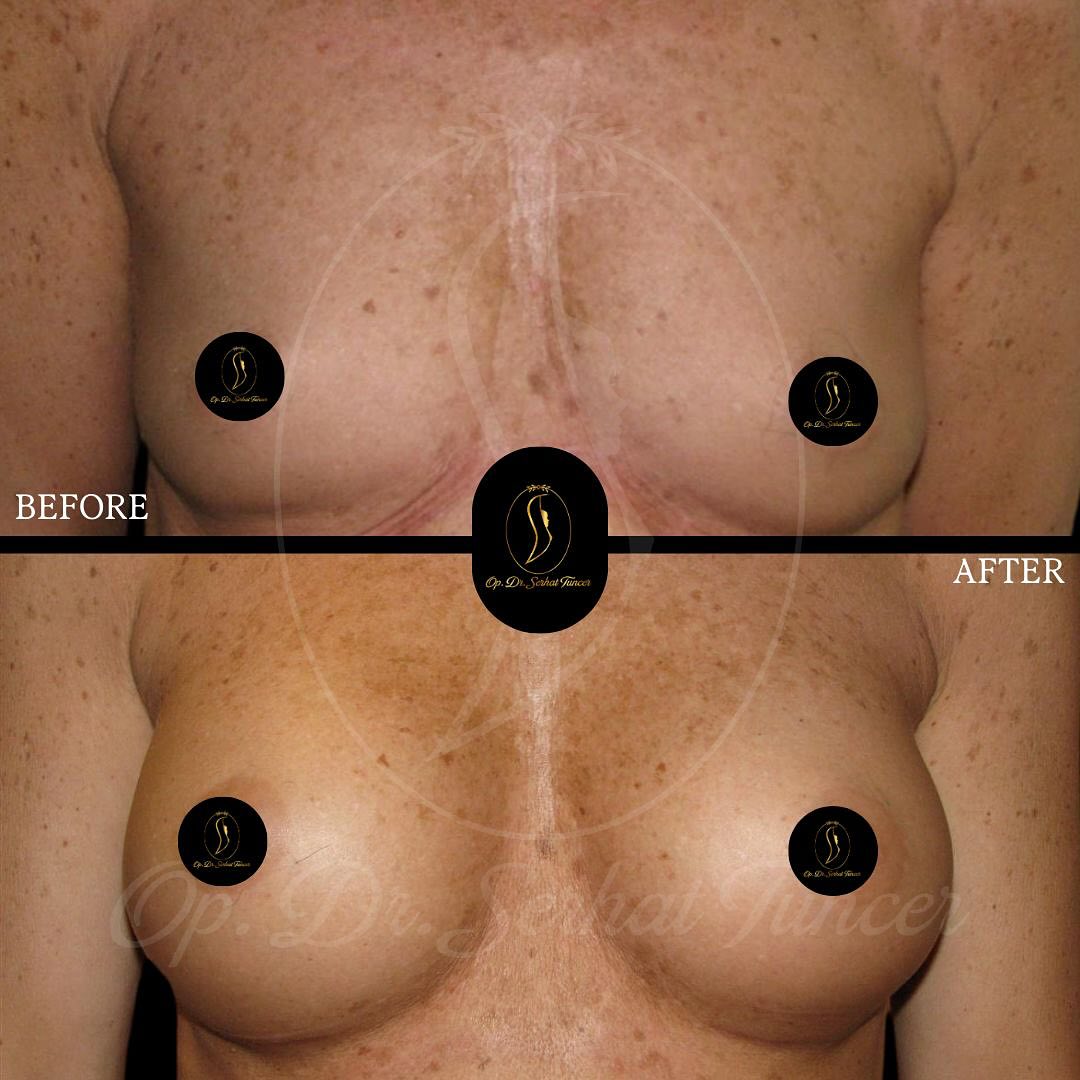 The transformation after breast augmentation surgery. 📷
Would you like to achieve your desired breast structure this year as well?
#plasticsurgery #breastaugmentation  #breastlift #surgery #beforeandafter #beauty #breastimplants #breastreduction  #germany #istanbul