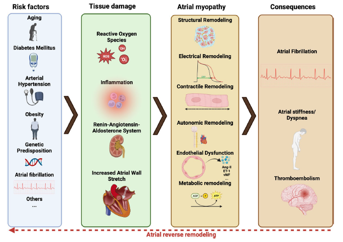 Atrial myopathy and fibrillation.
link.springer.com/article/10.100…