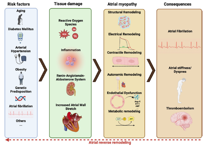 Atrial myopathy and fibrillation. link.springer.com/article/10.100…