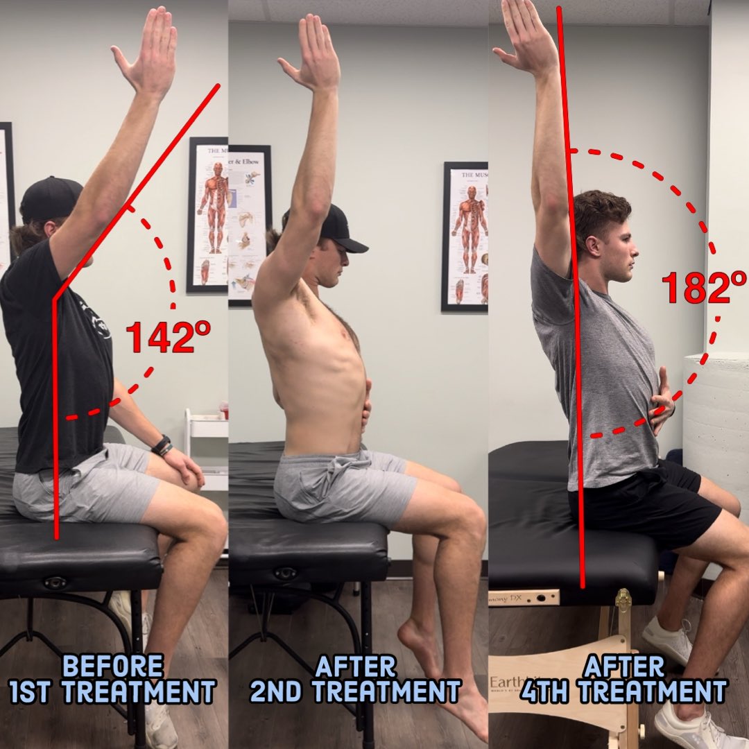 drjoshheenan's tweet image. Restoring ROM Post-op

@J_Oliger27 shown here from 12-14 weeks post-op with significant limitations in external rotation &amp;amp; flexion.

Typically, we want full passive ROM somewhere between week 4-10. Jake’s limitations were primarily neurological, not tissue restrictions.