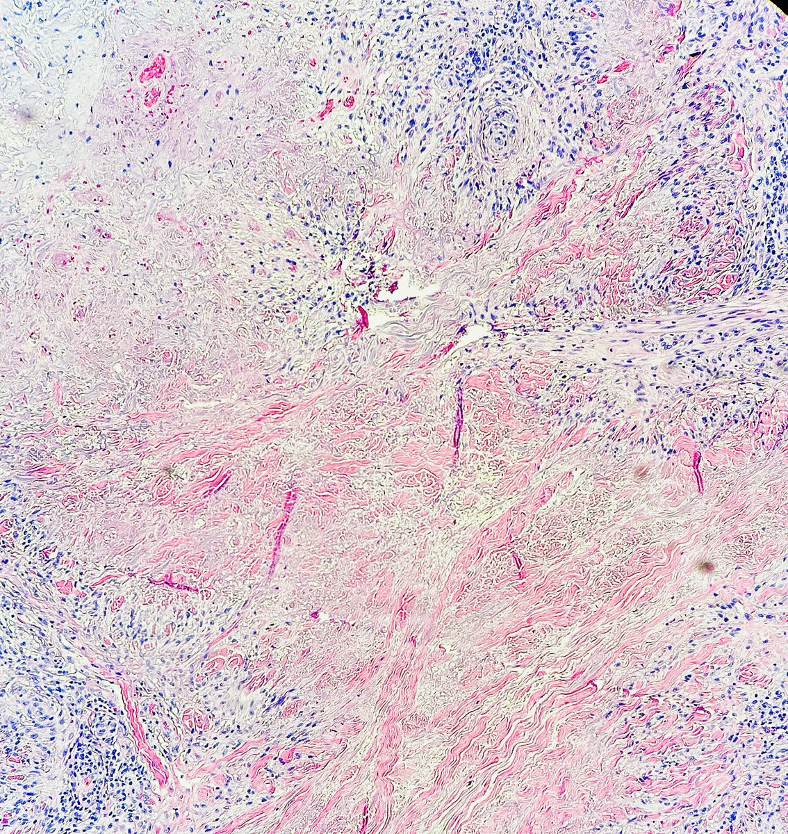 I am a self-limited condition that may be mistaken for a more sinister process (epithelioid sarcoma->cytokeratin+) I may appear as an annular plaque I have granulomatous inflammation with mucin and necrobiosis (degraded collagen) Who am I? #pathagonia #dermx #dermpath #pathx