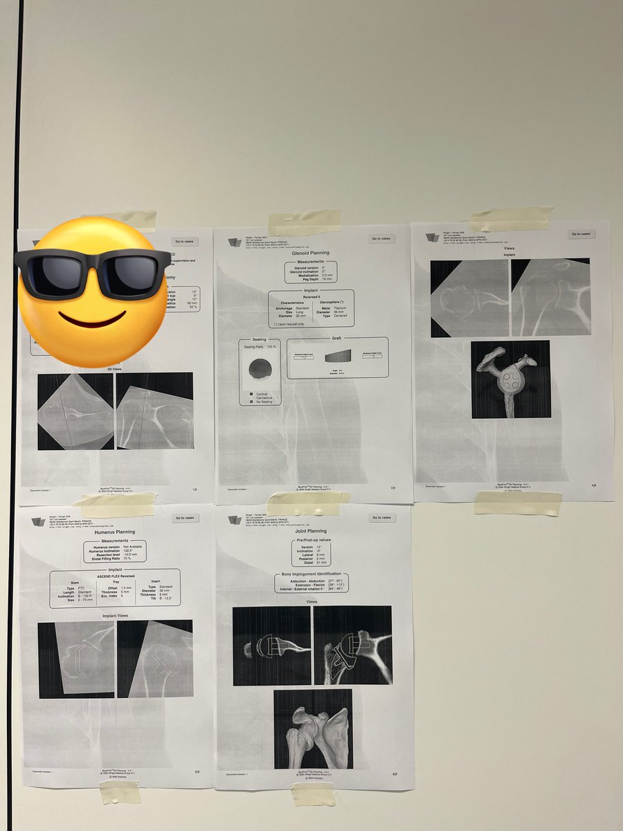 Failure to plan is a plan to fail. 5th case of the day, now BIO RSA  <a href="/TornierOR/">TornierOR</a> <a href="/wrightmedical/">Wright Medical</a> #shoulder #arthroplasty #reverse #bio #rsa <a href="/sechc_oficial/">SECHC</a> <a href="/sececessse/">SECEC</a> <a href="/HospitalReus/">Hospital Universitari Sant Joan de Reus</a>
