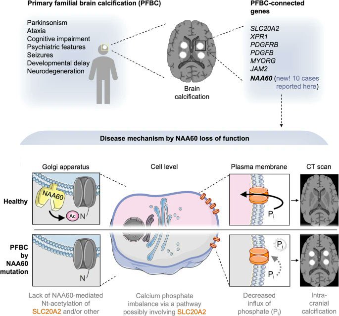 From @UCLBrainScience, with the support of a global team, I am thrilled to share our new disease-gene linked to Primary Familial Brain Calcification in @NatureComms. Read here how #NAA60 variants make the brain turn into calcified lumps disq.us/t/4nd64gp @ucl @IonSynapse