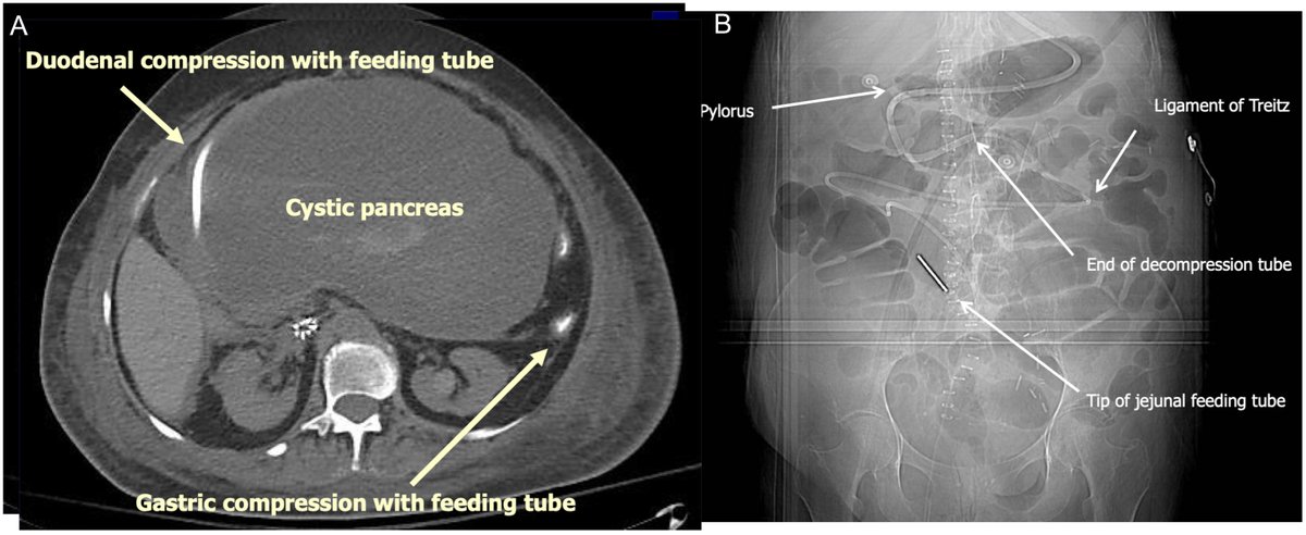 How best to feed patients with #severeacutepancreatitis ow.ly/qJKb50QStJh @VinayChandraMD