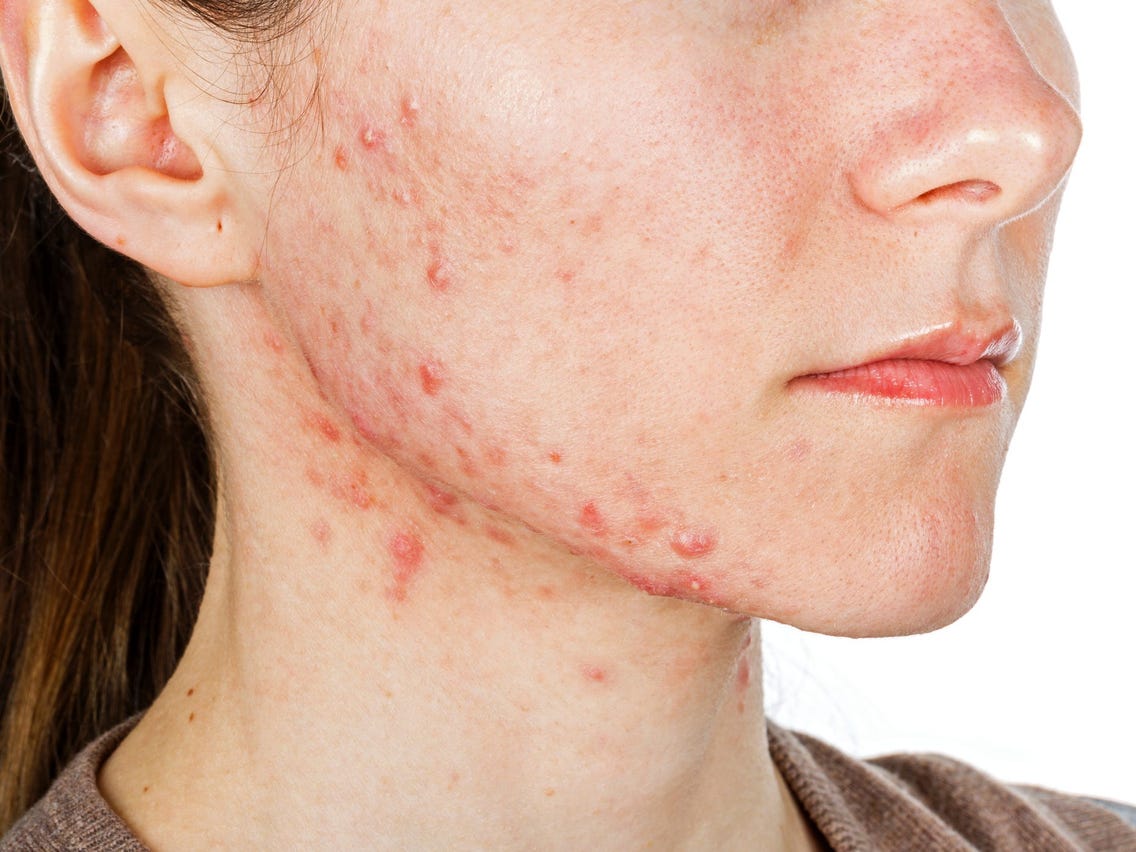 It's time to say goodbye to hormonal acne!

I nak share Top 5 Foods for Hormonal Acne and PCOS related Acne!