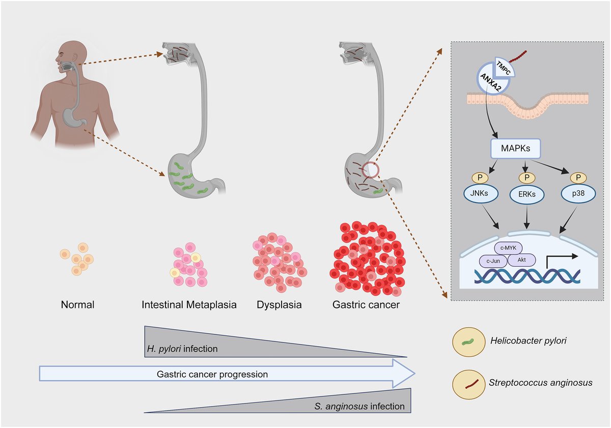 A tough act to swallow: Streptococcus anginosus & #GastricCancer. Wong & Tan @dukenus highlight work of Jun Yu @CUHKofficial identifying Streptococcus anginosus, a #bacterium normally residing in the oral cavity, as a contributor to gastric carcinogenesis cell.com/cell-host-micr…