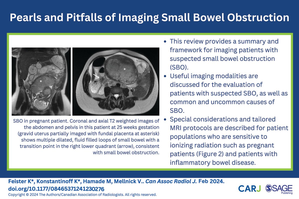 Check out this recently published review article on the pearls and pitfalls of imaging small bowel obstruction: doi.org/10.1177/084653… @MIRimaging @CARadiologists @SageJournals #radiology #radres