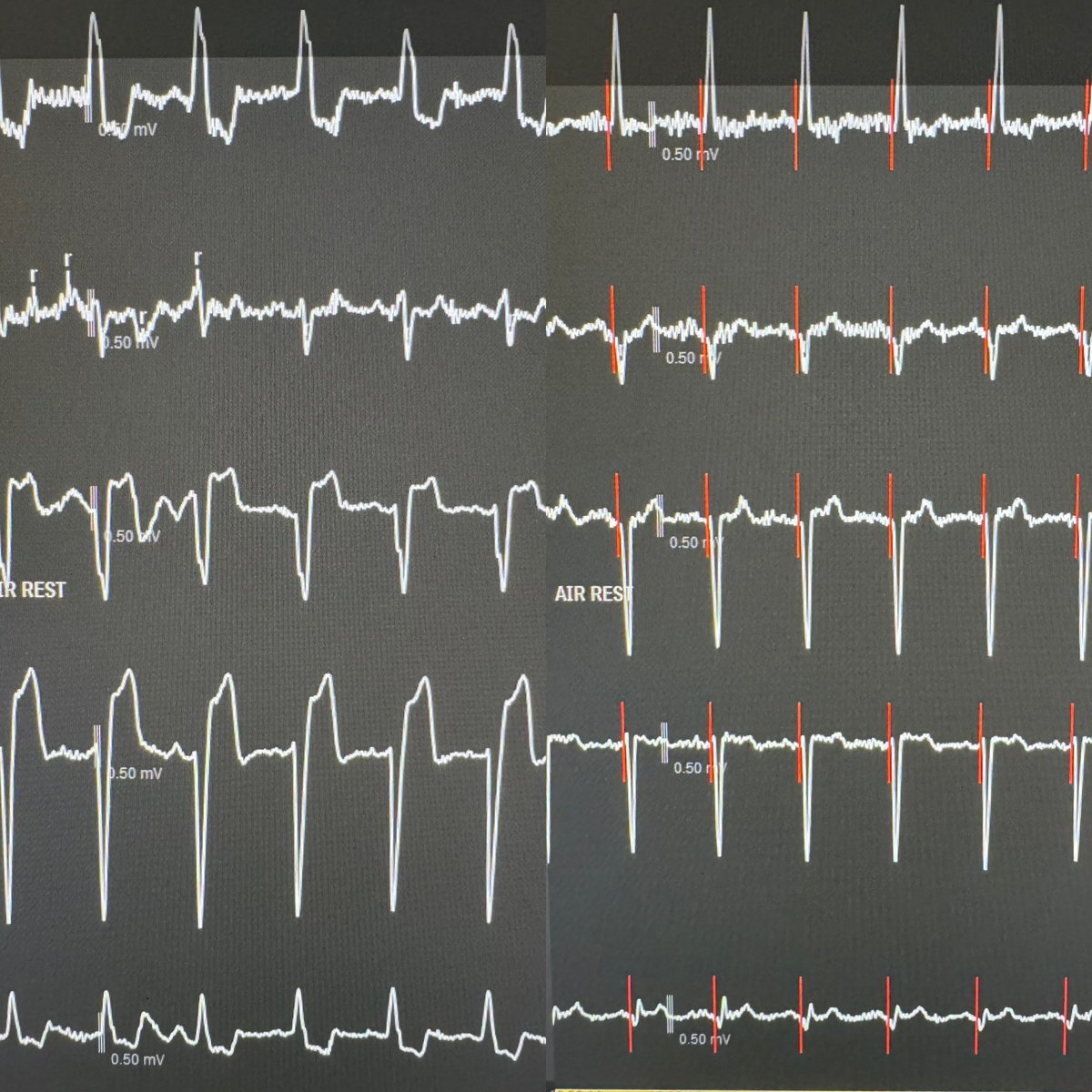 cardiochar's tweet photo. THIS is why it’s all worth it! 🫶🏻 

DCM. LBBB. QRSd 170ms. EF 25%. NYHA II.

Final BiV QRSd 96ms 🙌🏼 

Hopeful for significant HFQOL and EF ⬆️

@AbbottCardio #SyncAV #CRToptimisation https://t.co/ynm2mhIOoN