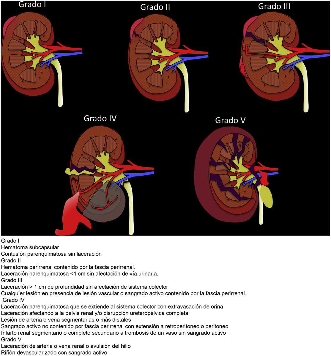 SERAM - Sociedad Española de Radiología Médica (@seram_rx) on Twitter photo En este artículo de la <a href="/RevistaRADIOLO2/">@RevistaRADIOLOGIA</a> se repasan las principales clasificaciones de los traumatismos abdominales, dependiendo del órgano afecto (hígado, bazo y riñón)
Los gráficos son muy ilustrativos, ¡no te lo pierdas! 🔗 bit.ly/3v8udpi En este artículo de la <a href="/RevistaRADIOLO2/">@RevistaRADIOLOGIA</a> se repasan las principales clasificaciones de los traumatismos abdominales, dependiendo del órgano afecto (hígado, bazo y riñón)
Los gráficos son muy ilustrativos, ¡no te lo pierdas! 🔗 bit.ly/3v8udpi