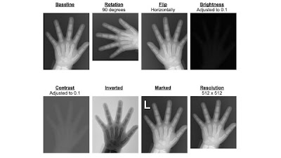 Award-winning bone age #DL model was brittle to variations in images doi.org/10.1148/ryai.2… @SamSantomartino @EBeheshtian @UM2ii #BoneAge #DeepLearning #MachineLearning