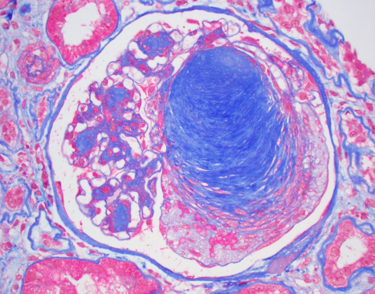 JZRenalPath's tweet photo. Mesangial nodule swallowing up the entire glomerulus.  #renalpath #PathTwitter https://t.co/8zbVsKoNAC