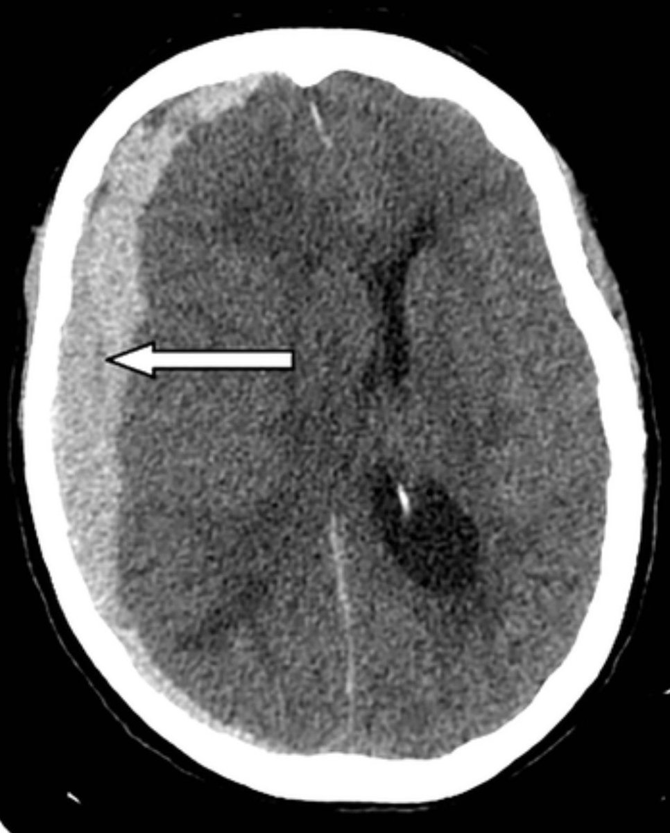 ardila11 (@alvaroardilao) on Twitter photo Hematoma Subdural agudo Hematoma Subdural agudo