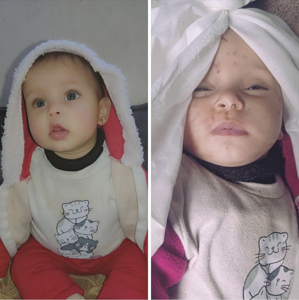🇵🇸Batoul, uma linda bebê!
Batoul ficou apavorada com o bombardeio israelense e buscou refúgio nos braços de sua mãe, mas Israel a matou nos braços de sua mãe hoje, 13 de março de 2024. Sua irmã gêmea Leen ainda está sob os escombros. Assim  é a infância é reconhecida em Gaza.