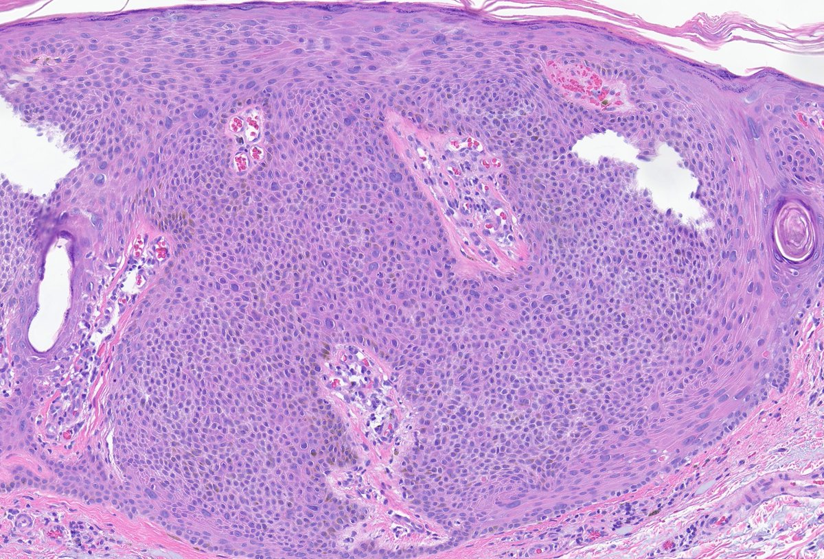 HENRYY_MD's tweet photo. what do you make these large "atypical" cells in an irritated SK? #dermpath 
@MarcelaSaebL @PIorfino @et565 @david_terrano @mccalmo @gonzadetoro @ArjunRamaiya1 @CakePath @AadilAhmedMD @redsnapperpath @DrGeeONE @kis_lorand https://t.co/9ntqNmTbBZ